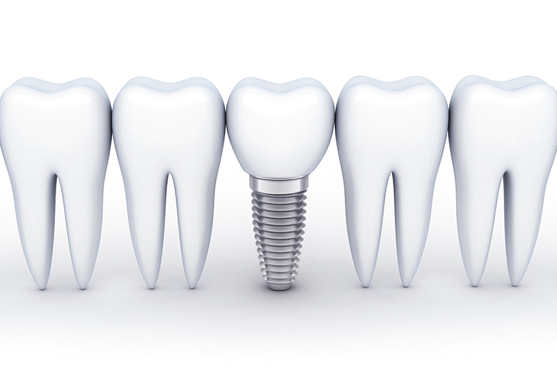 当院のインプラント治療